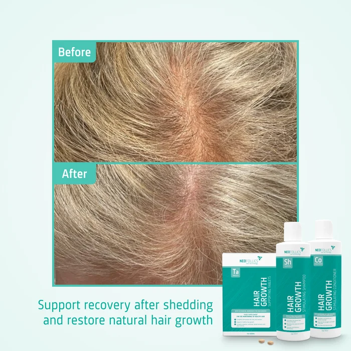 Hair Growth Telogen Effluvium routine before after