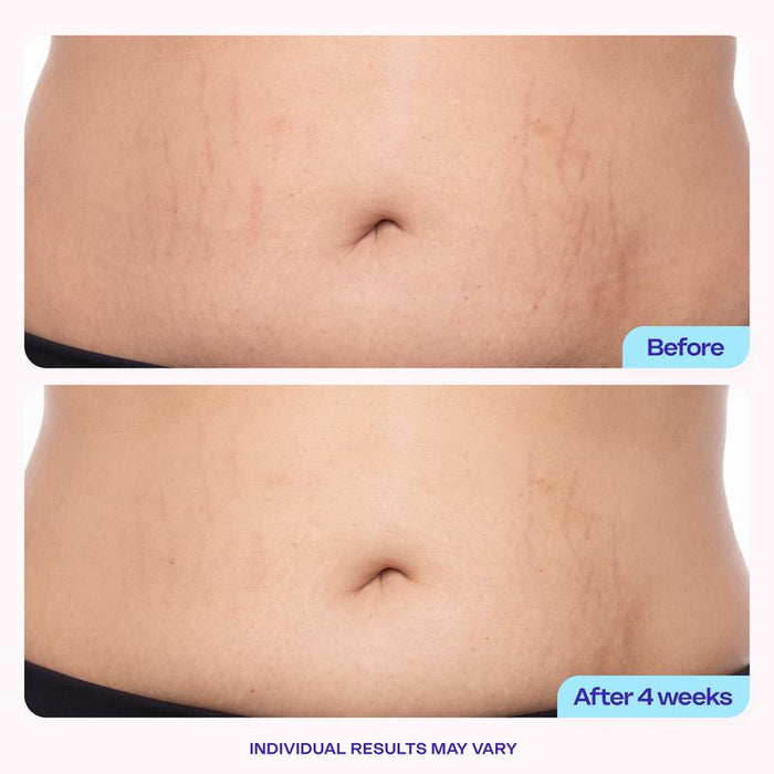🔥Holiday Limited Edition : 90% OFF🔥New! GOPURE Tighten & Smooth Belly Firming Cream
