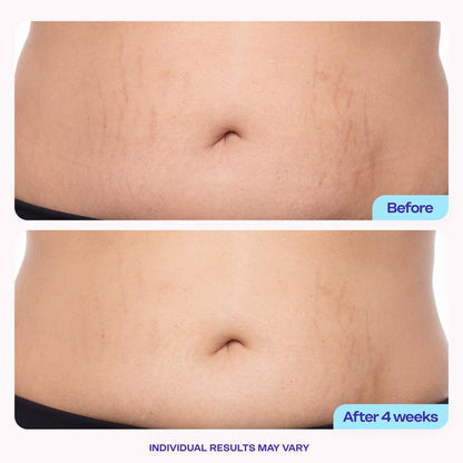 🔥Holiday Limited Edition : 90% OFF🔥New! GOPURE Tighten & Smooth Belly Firming Cream
